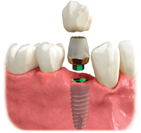 Individual Dental Implants
